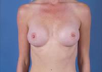before after breast augmentation