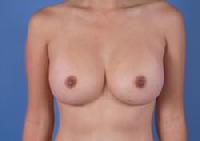 before after breast augmentation