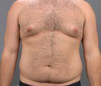before after male abdominoplasty tummy tuck