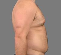 before after male abdominoplasty tummy tuck