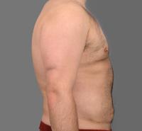 before after male abdominoplasty tummy tuck