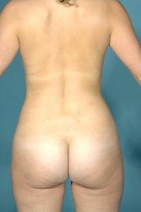 before after liposuction abdomen flanks
