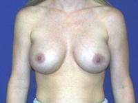before after breast implant exchange