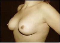 before after breast reduction