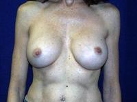 before after breast implant exchange