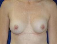 before after breast implant exchange