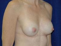 before after breast implant exchange