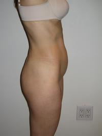 before after liposuction abdomen flanks
