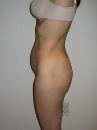 before after liposuction abdomen flanks