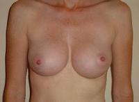 before after breast augmentation