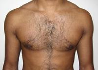 before after liposuction male chest