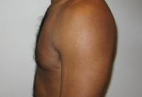 before after liposuction male chest