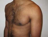 before after liposuction male chest