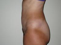 before after liposuction abdomen flanks