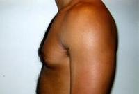 before after liposuction male chest