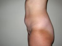 before after liposuction abdomen flanks