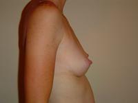 before after breast augmentation