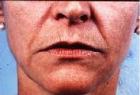 before after dermabrasion