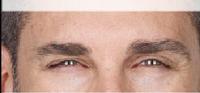 before/after xeomin men