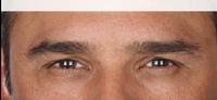 before/after xeomin men