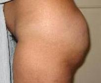 before after fat grafting body