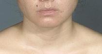 before after liposuction neck