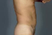 before after liposuction male abdomen flanks