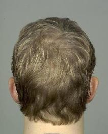 before after ear pinning otoplasty