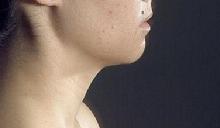 before after liposuction neck