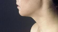 before after liposuction neck