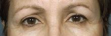 before after eyelid surgery blepharoplasty