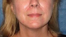 before/after liposuction neck