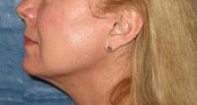 before/after liposuction neck