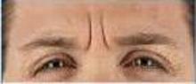 before/after xeomin