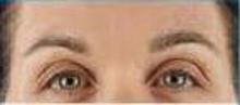 before/after xeomin