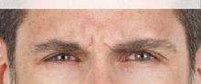 before/after xeomin men