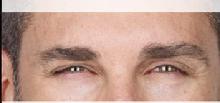 before/after xeomin men