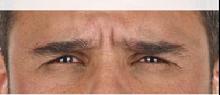 before/after xeomin men