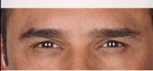 before/after xeomin men
