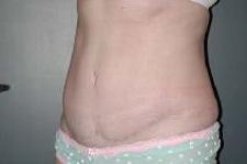 before after tummy tuck abdominoplasty