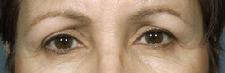 before after laser skin resurfacing