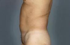 before after liposuction male abdomen flanks