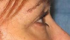 before after eyelid surgery blepharoplasty