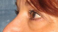 before after eyelid surgery blepharoplasty