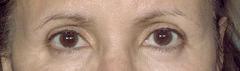 before after eyelid surgery blepharoplasty