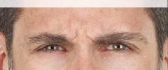 before/after xeomin men