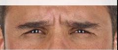 before/after xeomin men