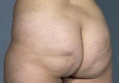 before after fat grafting body