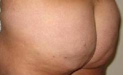 before after fat grafting body