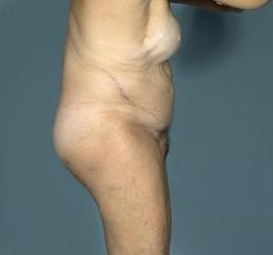 before after tummy tuck abdominoplasty